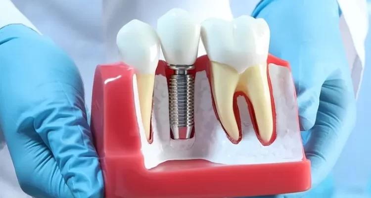 իմպլանտ արժեք